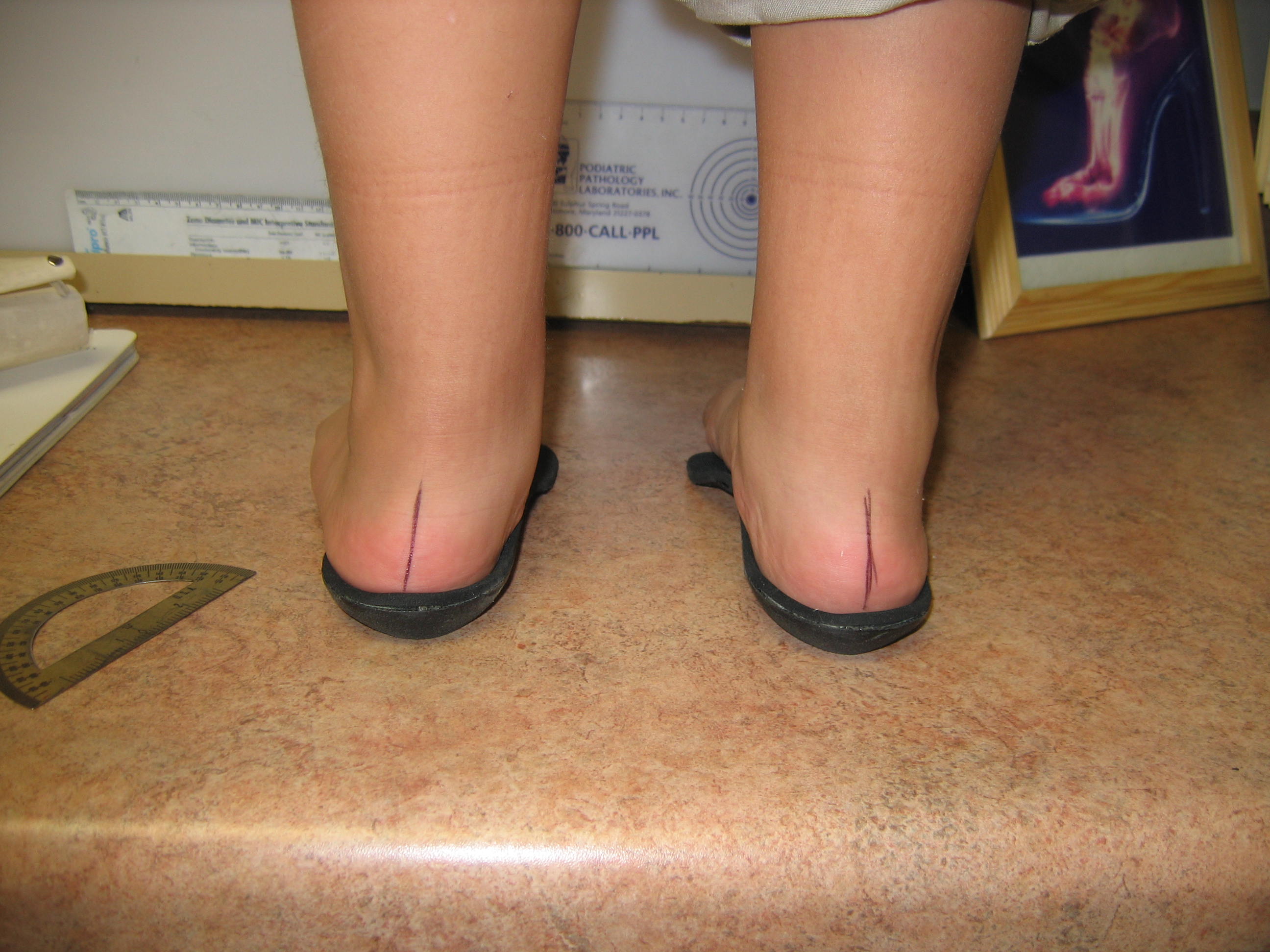 flat feet symptoms